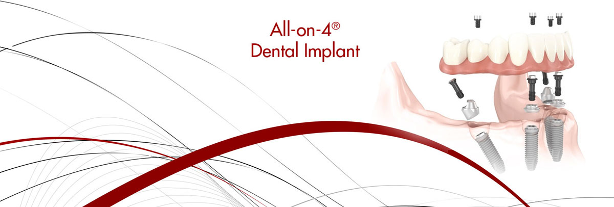 Montville All-on-4 Dental Implants