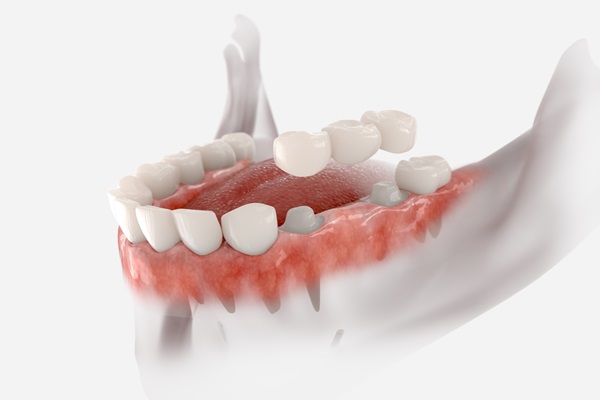 Can A Dental Bridge Help With Teeth Alignment?