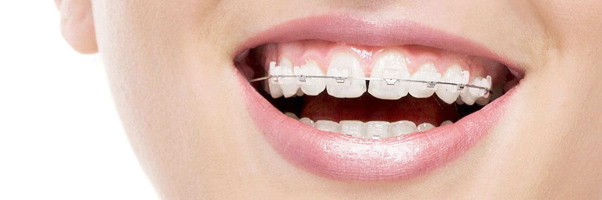 Montville Invisible Orthodontics
