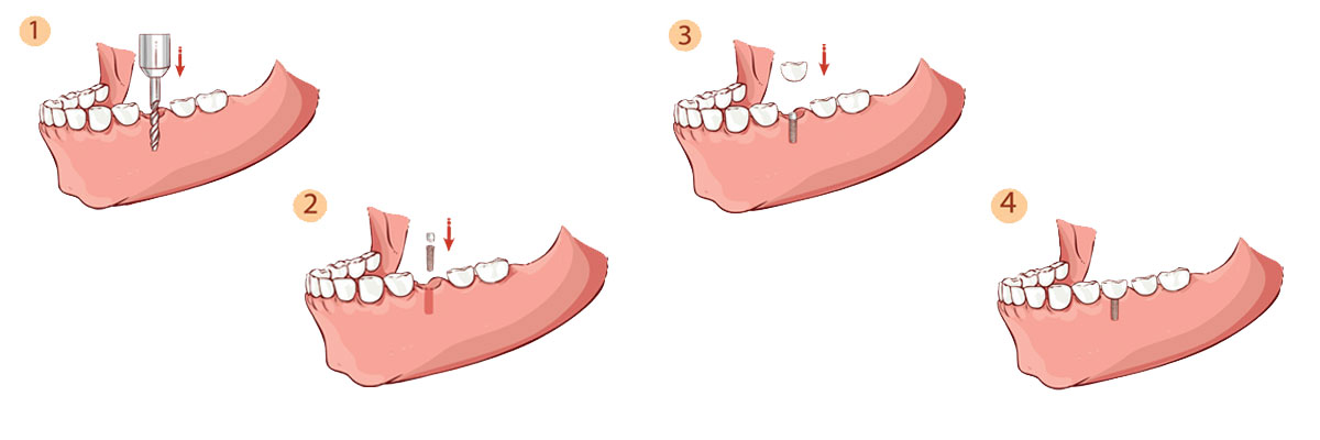 Montville The Dental Implant Procedure