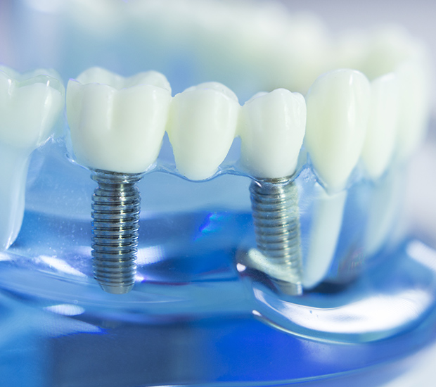 Montville Dental Implants