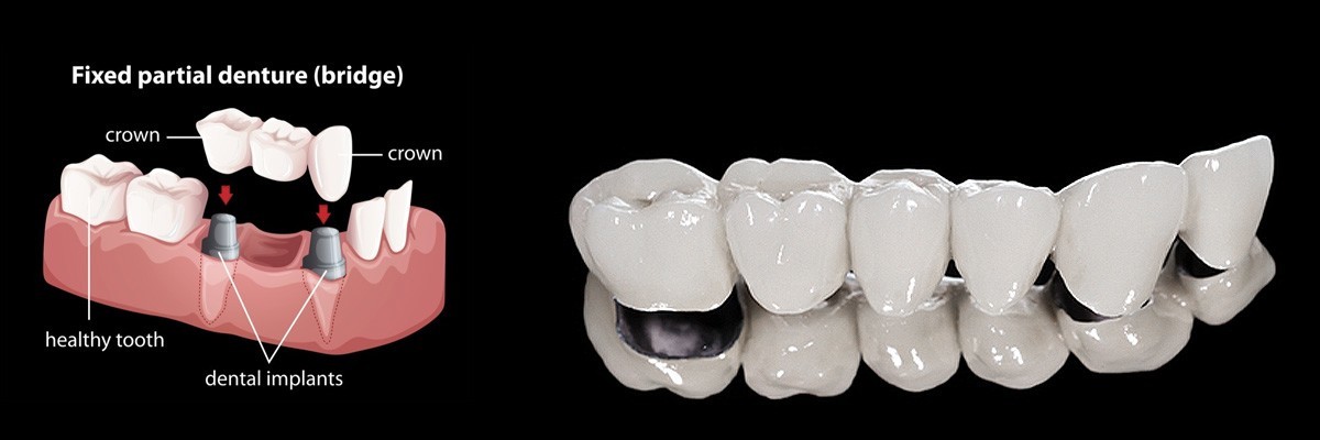 Montville Dentures