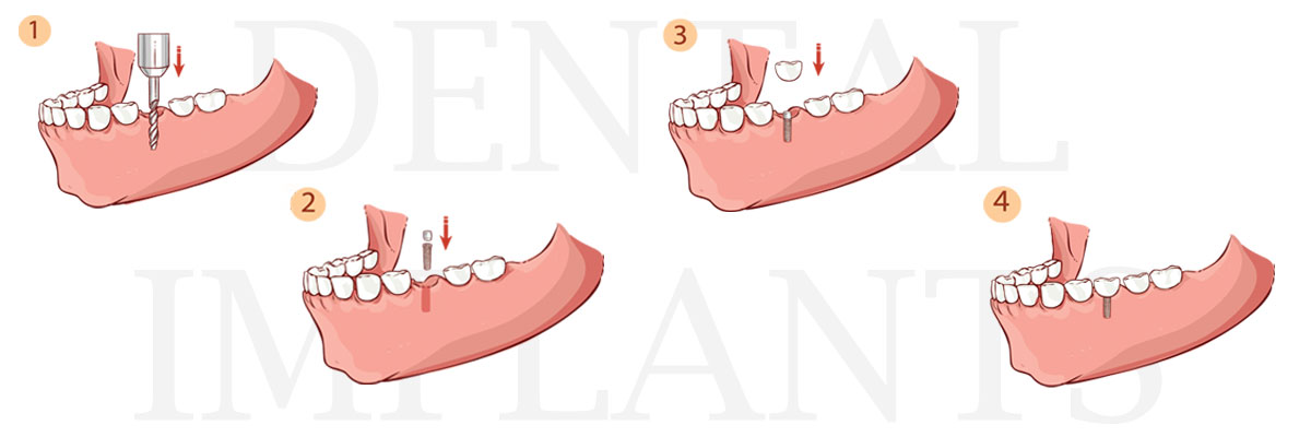 Montville The Difference Between Dental Implants and Mini Dental Implants