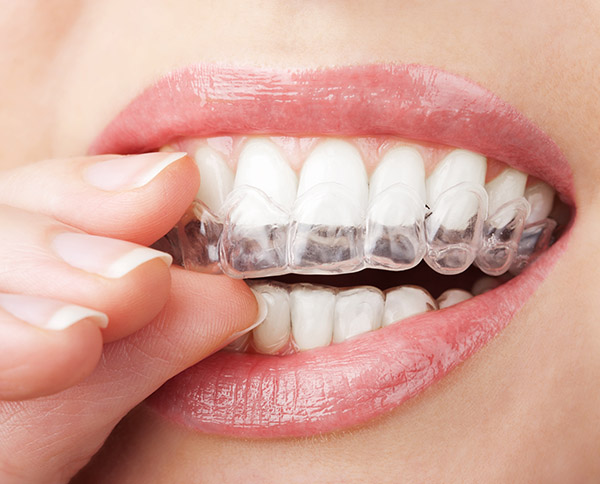 Invisalign: A More Conservative Option Than Traditional Orthodontics
