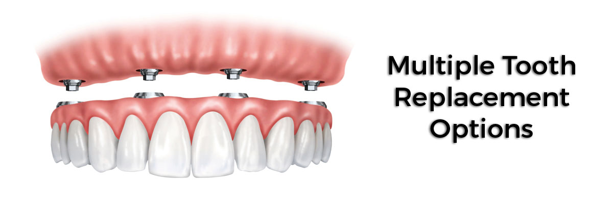 Montville Multiple Teeth Replacement Options
