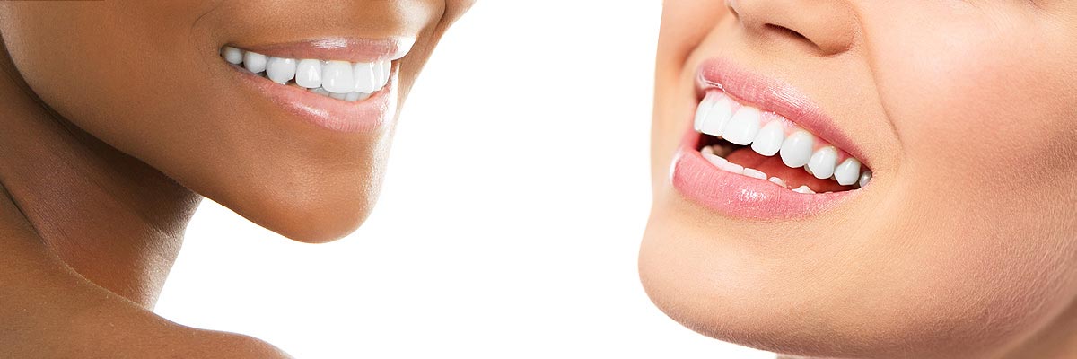 Montville Teeth Whitening