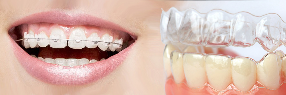 Montville Which is Better Invisalign or Braces