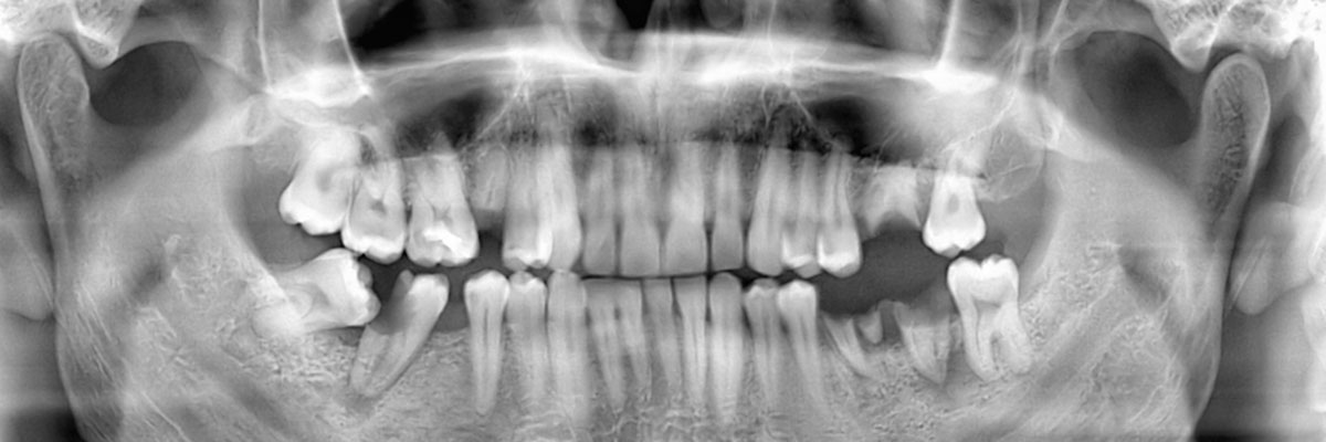 Montville Wisdom Teeth Extraction